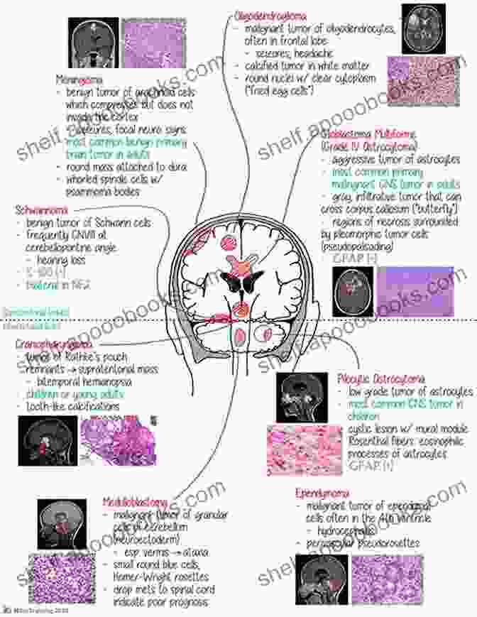 A Medical Student Studying A Pathological Illustration Of A Brain Tumor Visualizing Disease: The Art And History Of Pathological Illustrations