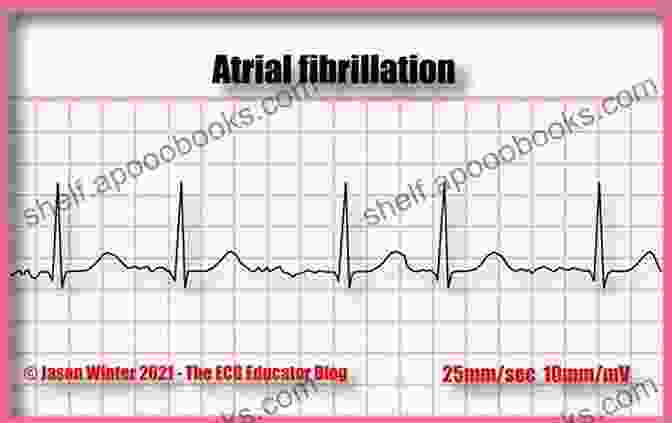 Electrocardiogram And Atrial Fibrillation Miniatlas: Visual Guide To AFib Diagnosis Electrocardiogram And Atrial Fibrillation Miniatlas