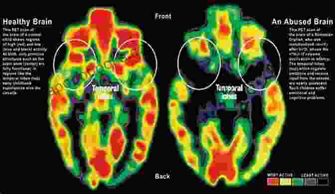 Image Of A Brain Scan Showing The Effects Of Trauma The Language Of Trauma: War And Technology In Hoffmann Freud And Kafka