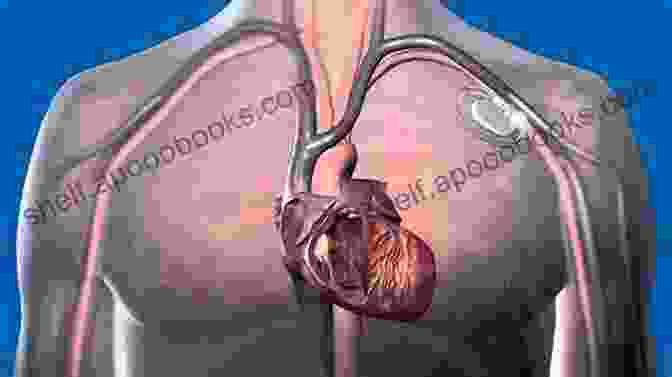 Image Of A Pacemaker Being Implanted In A Patient Update Of Non Pharmacological Therapy For Heart Failure