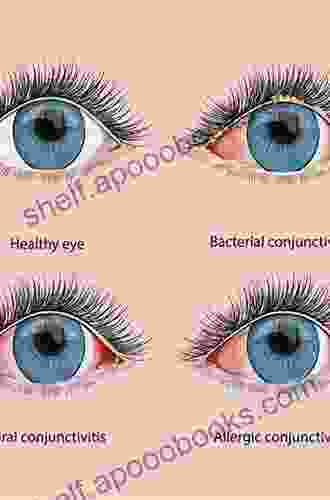 Infections Of The Cornea And Conjunctiva